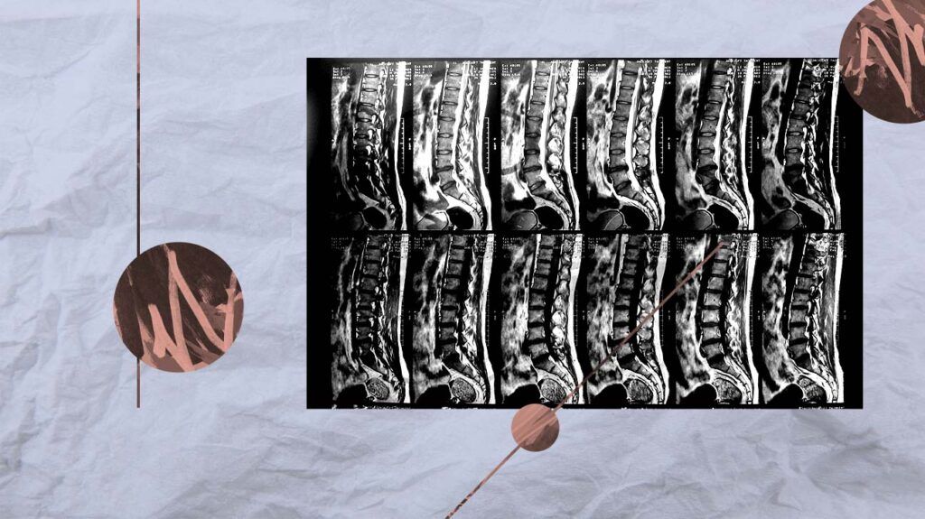 a collage with an MRI of the lumbar spine