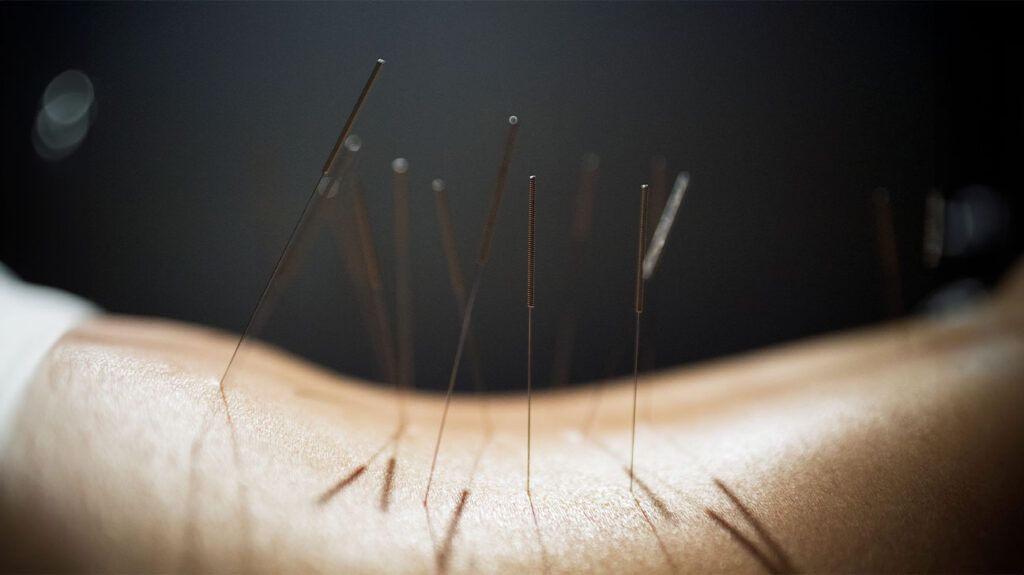 A person undergoing acupuncture to treat symptoms of endometriosis -1.