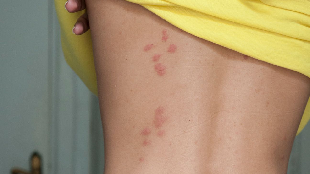 bug bite on back