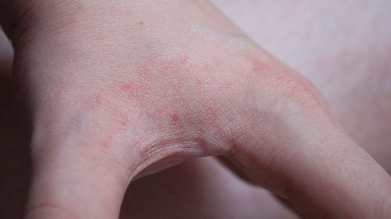 Bites but No Signs of Bed Bugs: How to Identify Bedbug Bites