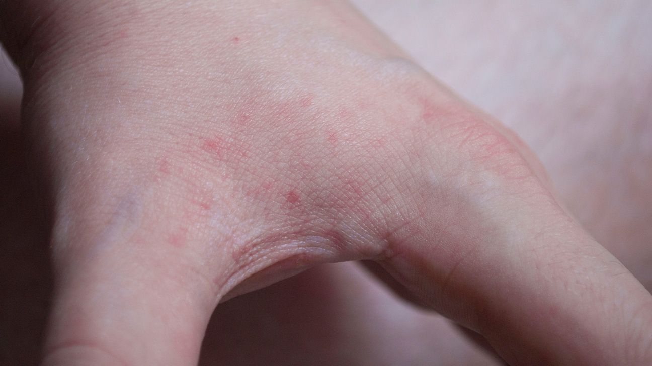 bug bites on hand