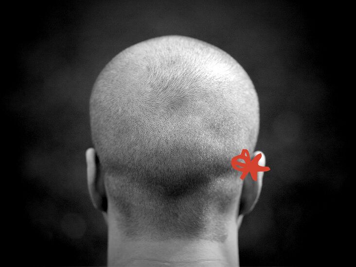 Bump on the back of the head: Causes and when to consult a doctor