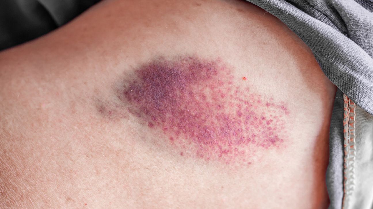 Why do I bruise easily? 8 Reasons it may happen