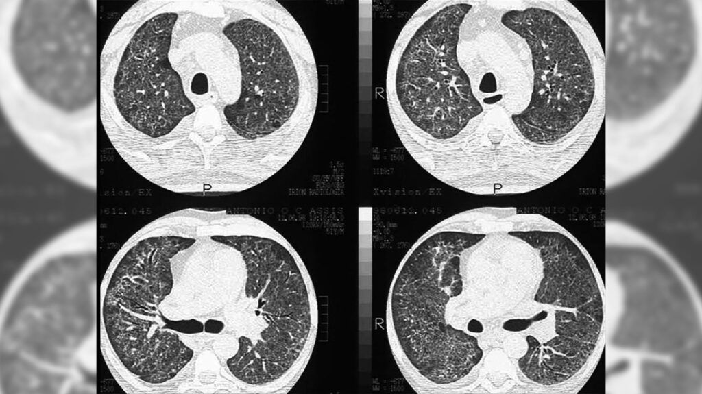 A CT scan of the lungs displaying a mosaic pattern of ground glass opacity.