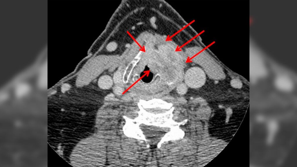 CT scan showing stage 4 laryngeal cancer.