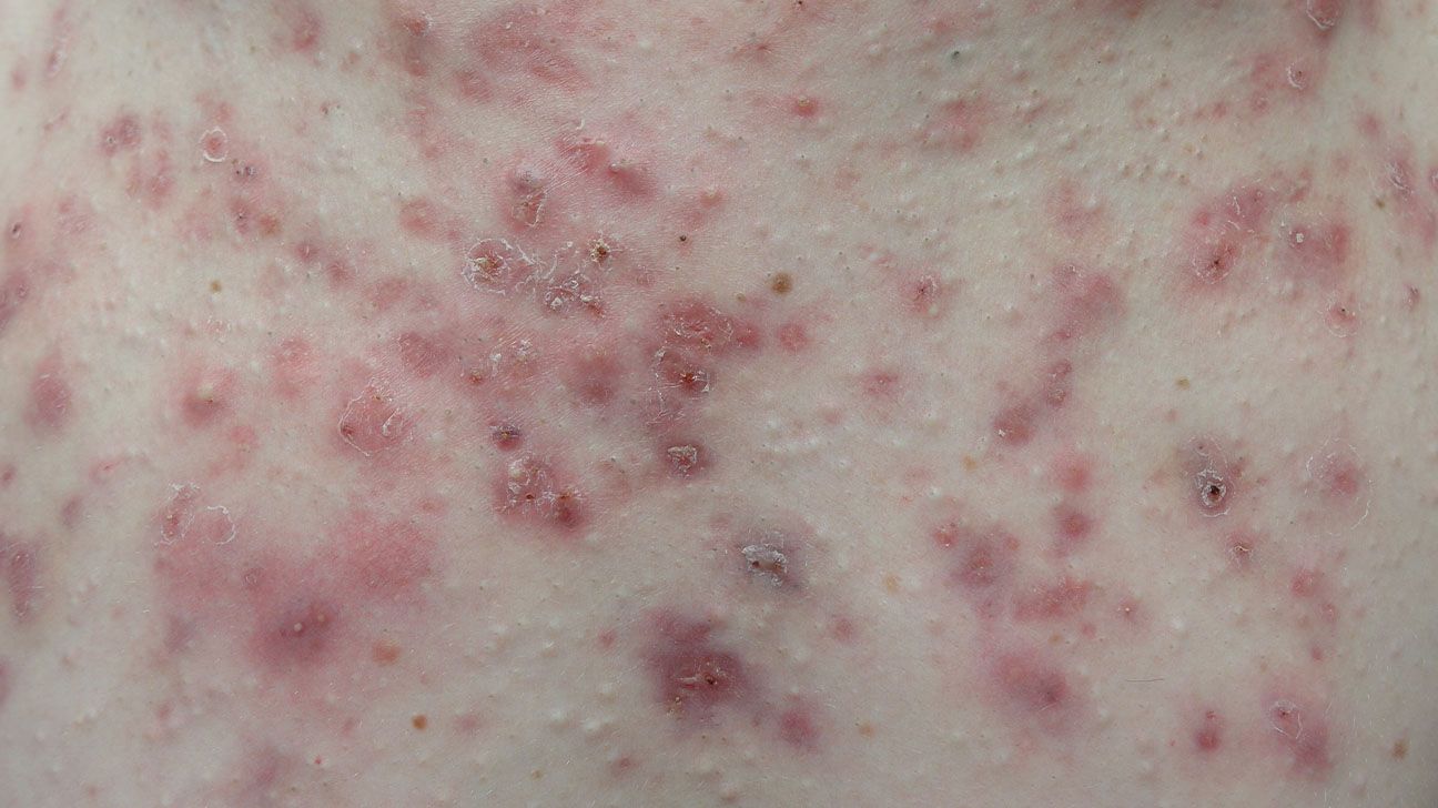 acne] Tons of small acne papules on chest out of nowhere - wedding is in  2.5 months - help me understand what is causing this! (Products and routine  are in comments) : r/SkincareAddiction