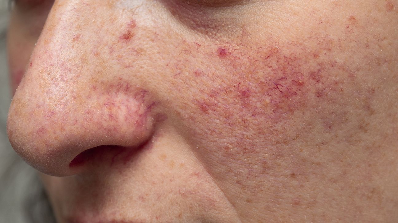 What Causes Red Face In Pregnancy
