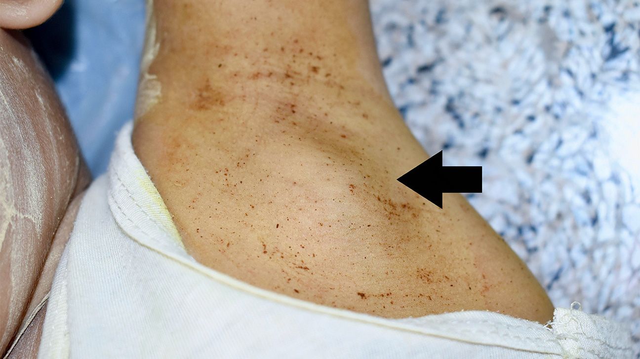 Hard lump under the skin: Causes and pictures