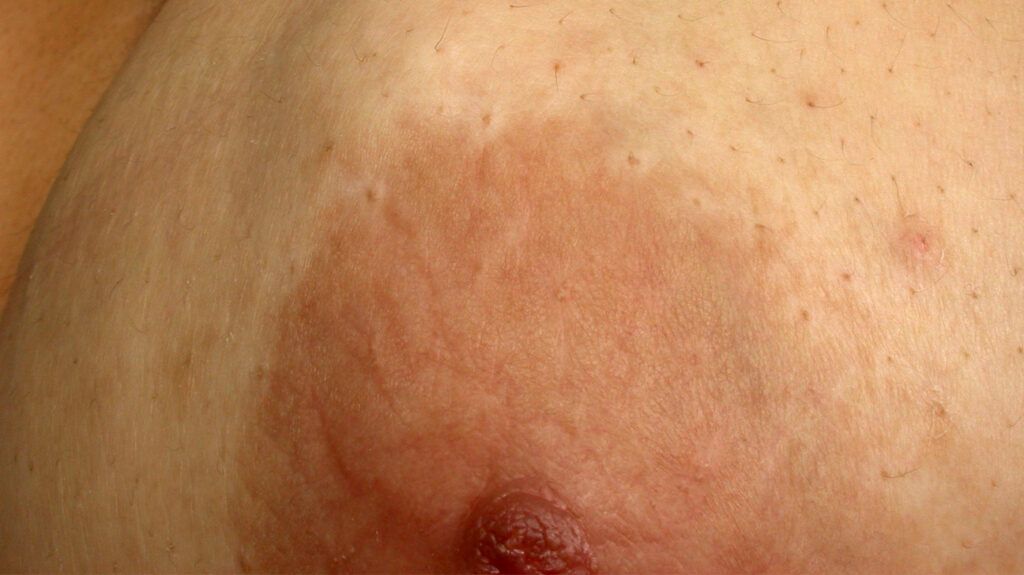 Hard lump under the skin: Causes and pictures