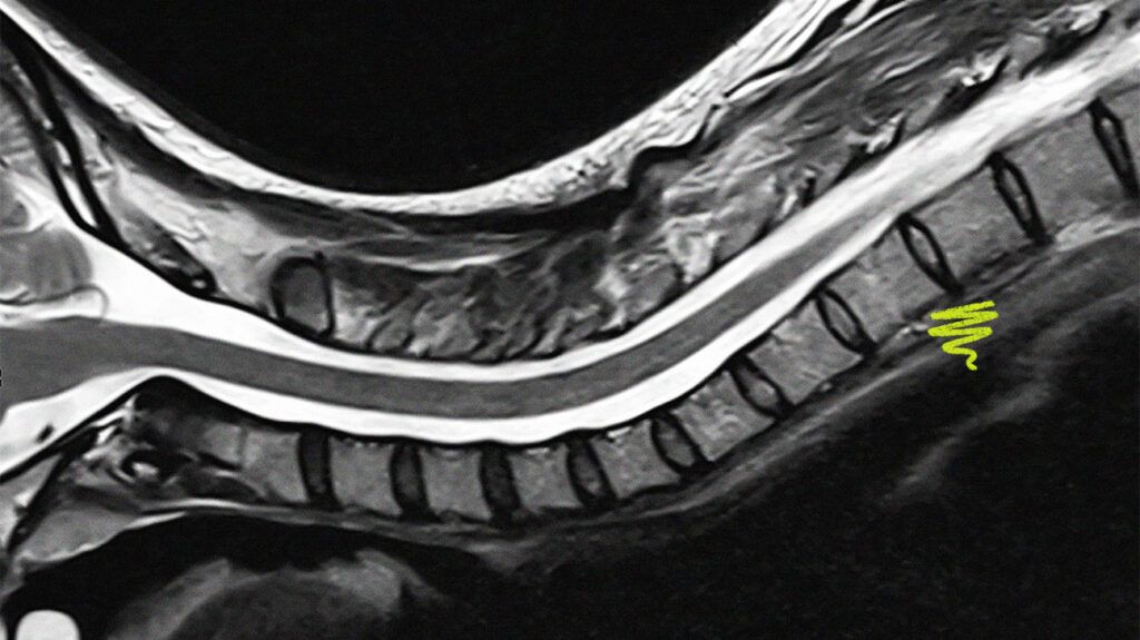 MRI of the cervical spine.