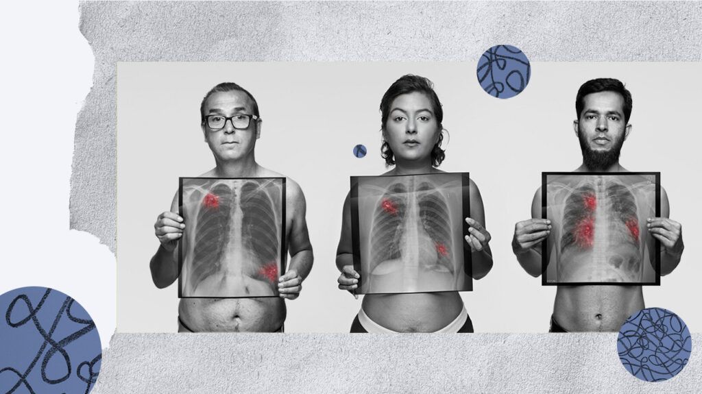 collage of three lung cancer survivors holding chest X-rays