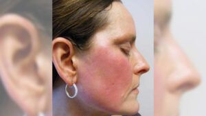 Neurogenic rosacea: Symptoms, causes, and more Neurogenic rosacea: Symptoms, causes, and more
