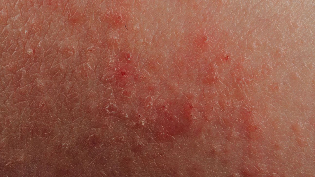 Butt Rash: Causes and Remedies