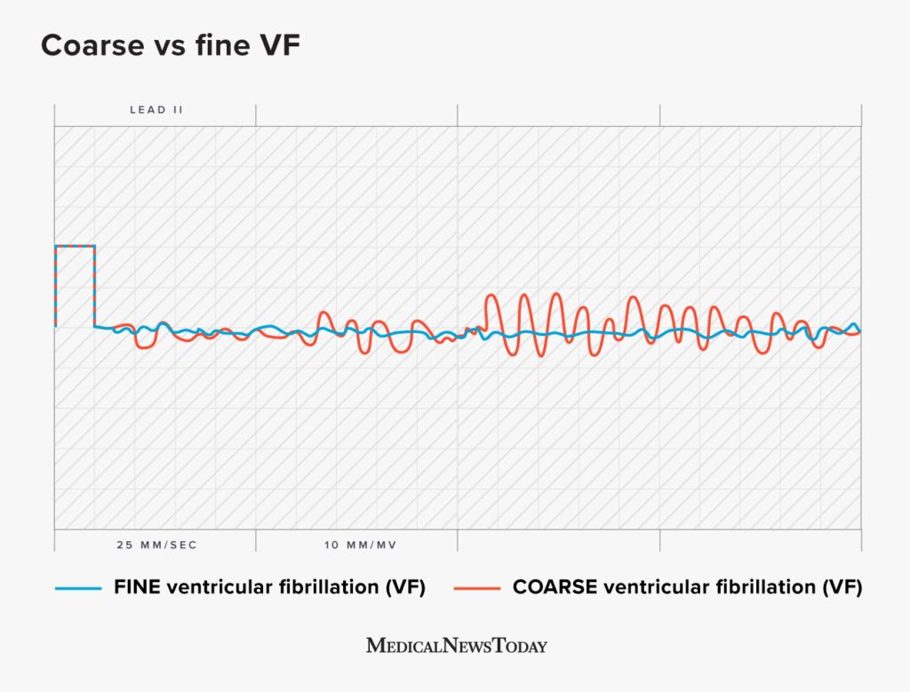 Illustration depicting the difference between coarse and fine ventricular fibrillation.