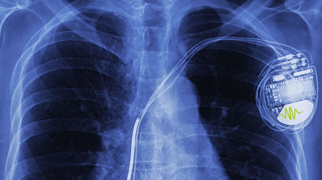 There is an X-ray showing a pacemaker.