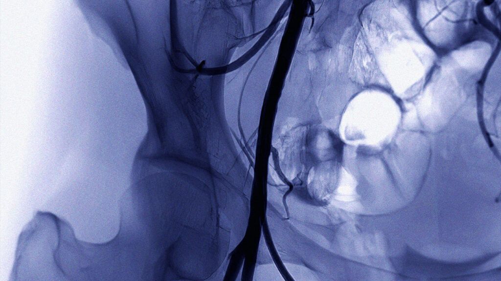 Femoral angiogram of the femoral artery.