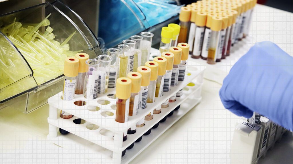 Urine test for leukocyte esterase.