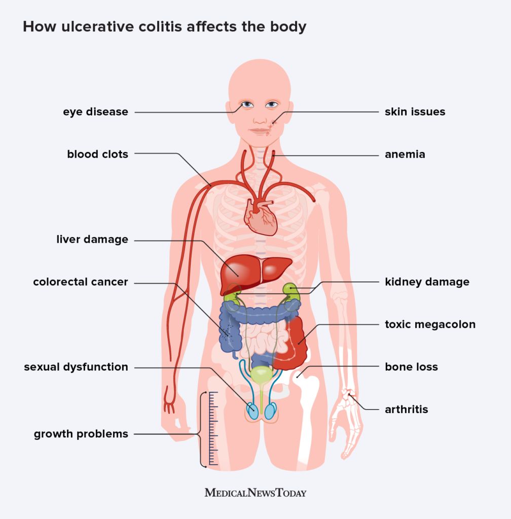 illustrated body map of how ulcerative colitis affects the body