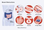 Bowel Obstruction Symptoms Causes Treatment And Diet