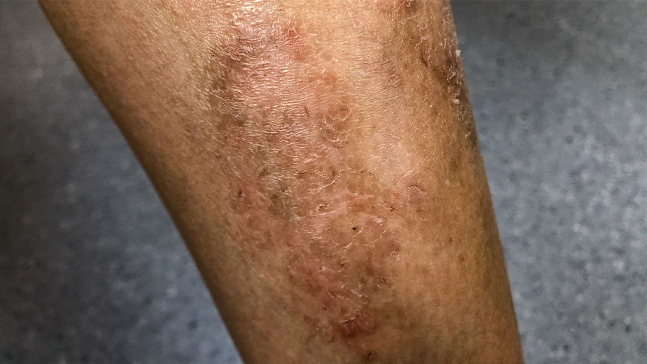 What Causes Dark Scaly Spots On Skin - Infoupdate.org