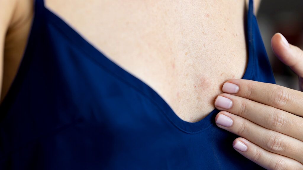 hives-on-the-breast-causes-symptoms-and-more