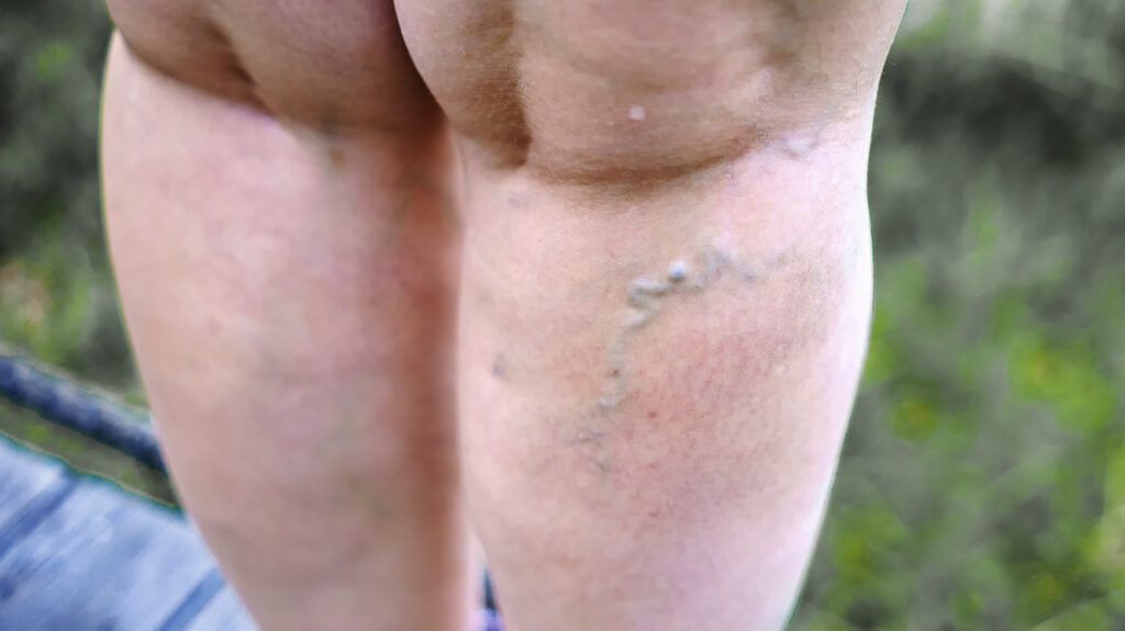 Swollen veins on the back of a leg-1