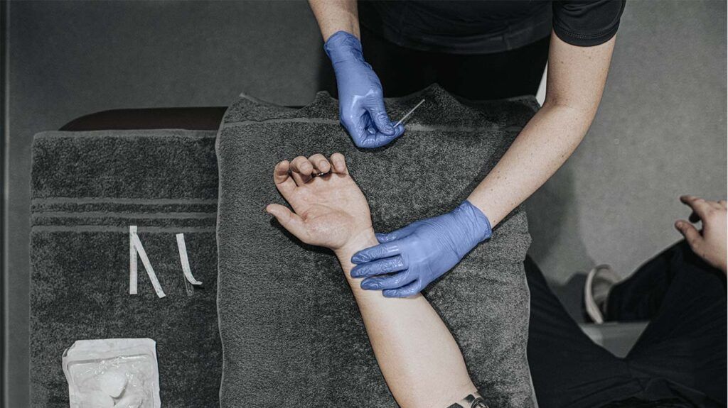 Professional performing acupuncture on a person's arm