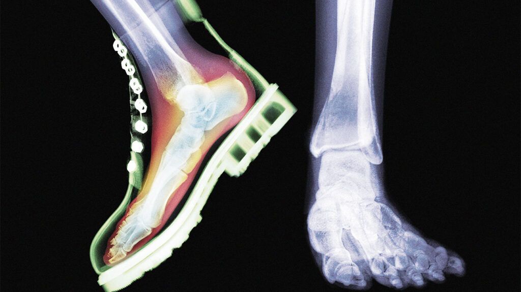 X-ray of feet with one foot in a boot.