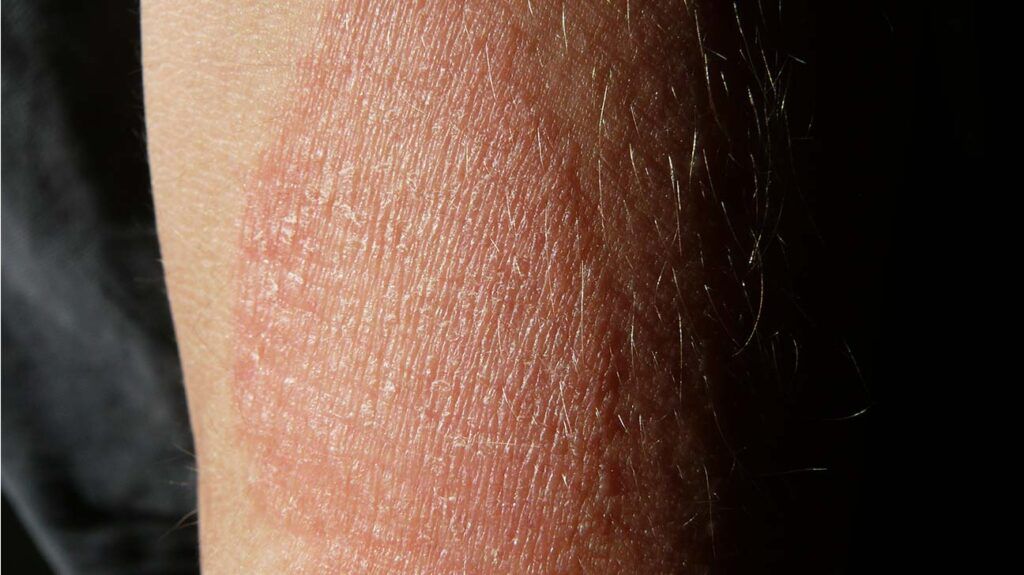 Contact dermatitis around a wound. The person was sensitive to the bandage used to wrap around the injury.