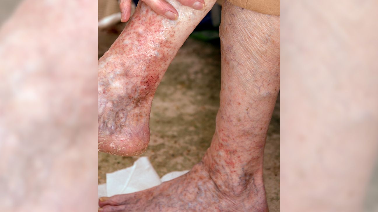 Peripheral vascular disease in the foot Symptoms and pictures