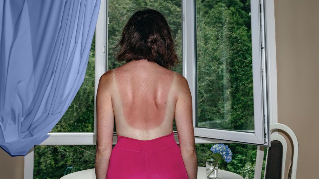 a woman with sunburn on her back looking out of a window