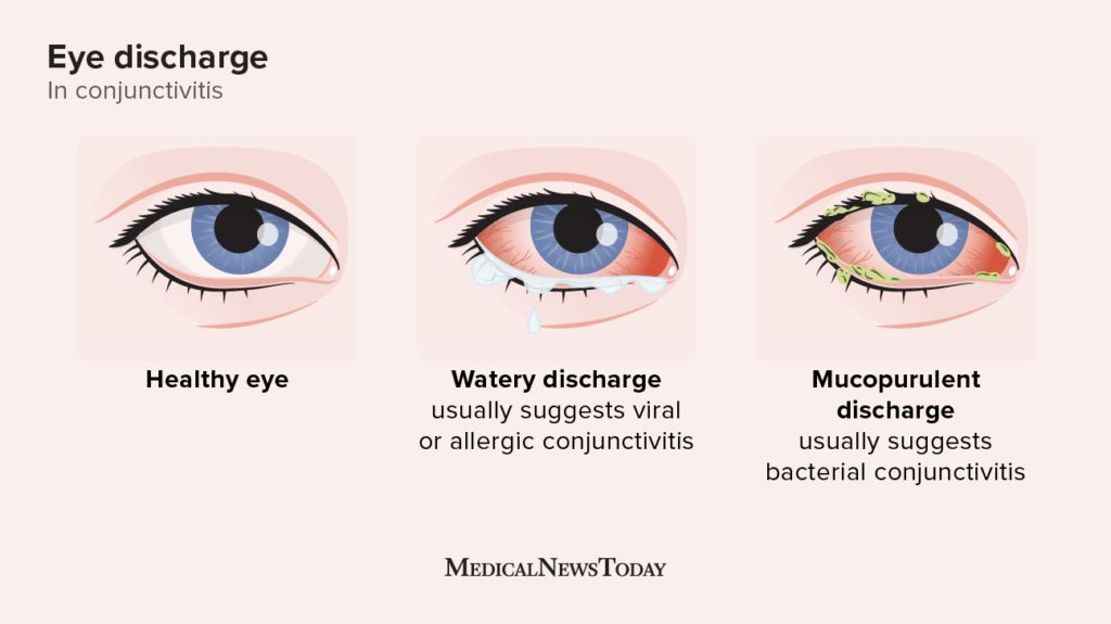 An illustration showing a healthy eye, an eye with watery discharge, and an eye with pus.