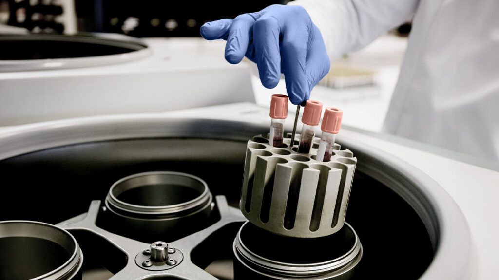 Lo screening dei test per 11 biomarcatori del sangue potrebbe prevedere la demenza in 15 anni…