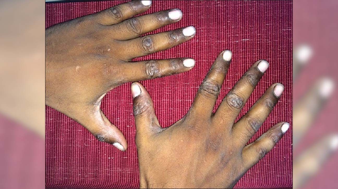 Dyshidroticlike Contact Dermatitis and Paronychia Resulting From a Dip  Powder Manicure | MDedge Dermatology