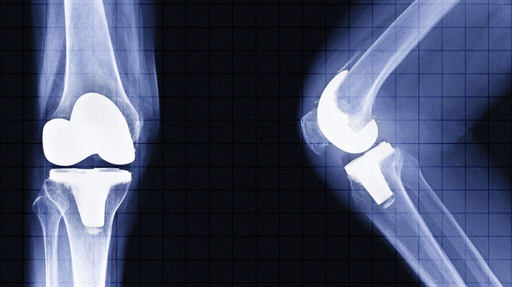 There is an X-ray of a knee joint.