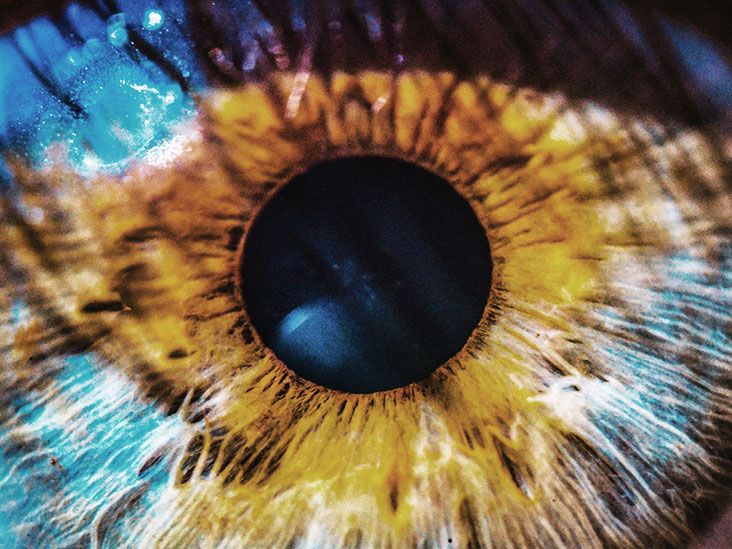 Neovascular macular degeneration Causes and symptoms