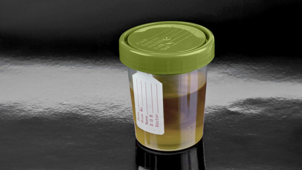 A cup with a urine sample