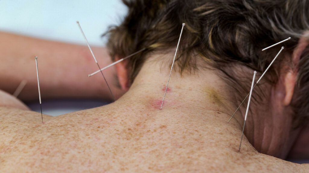 Woman having acupuncture on her neck