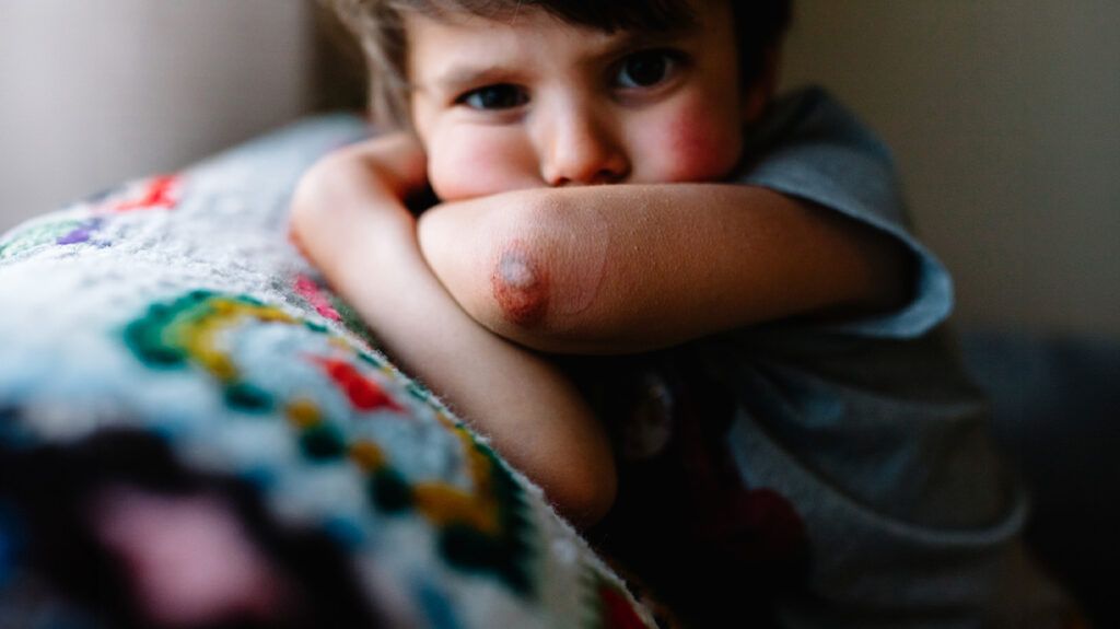A child with a scab on their elbow.-1