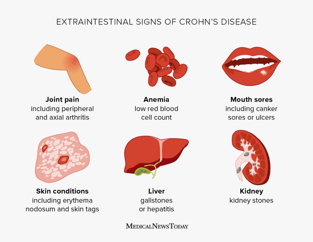 Extraintestinal signs of Crohn's disease.