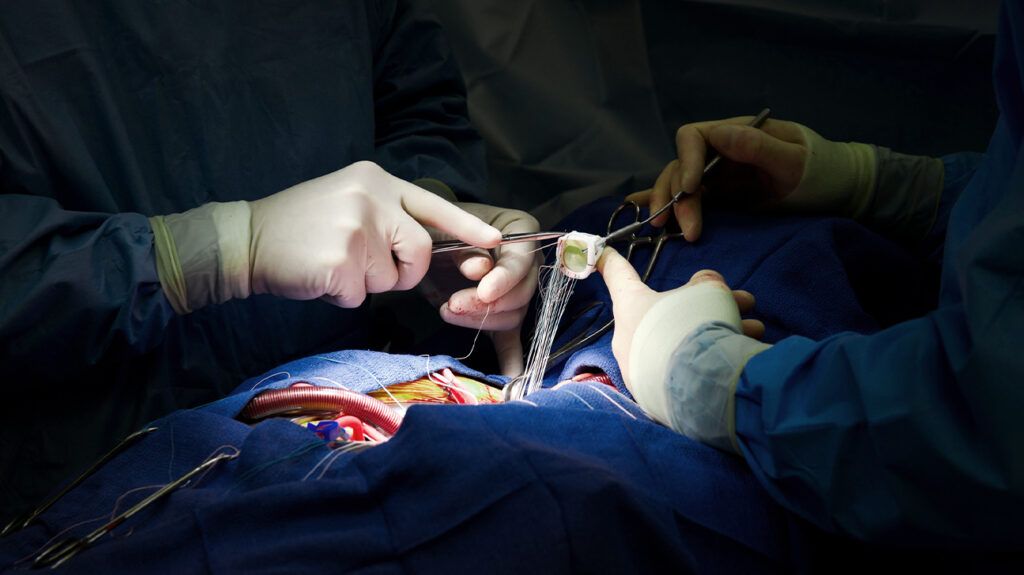 A person under blue sheets having open heart surgery, with the hands of surgeons working above the incision.
