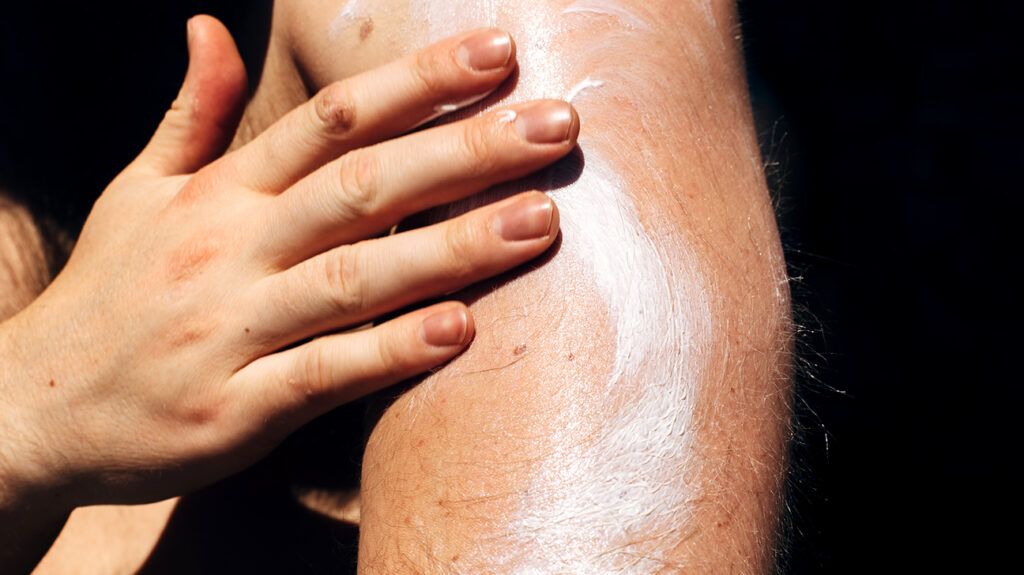 A person applying lotion to ease itching due to eczema -1.
