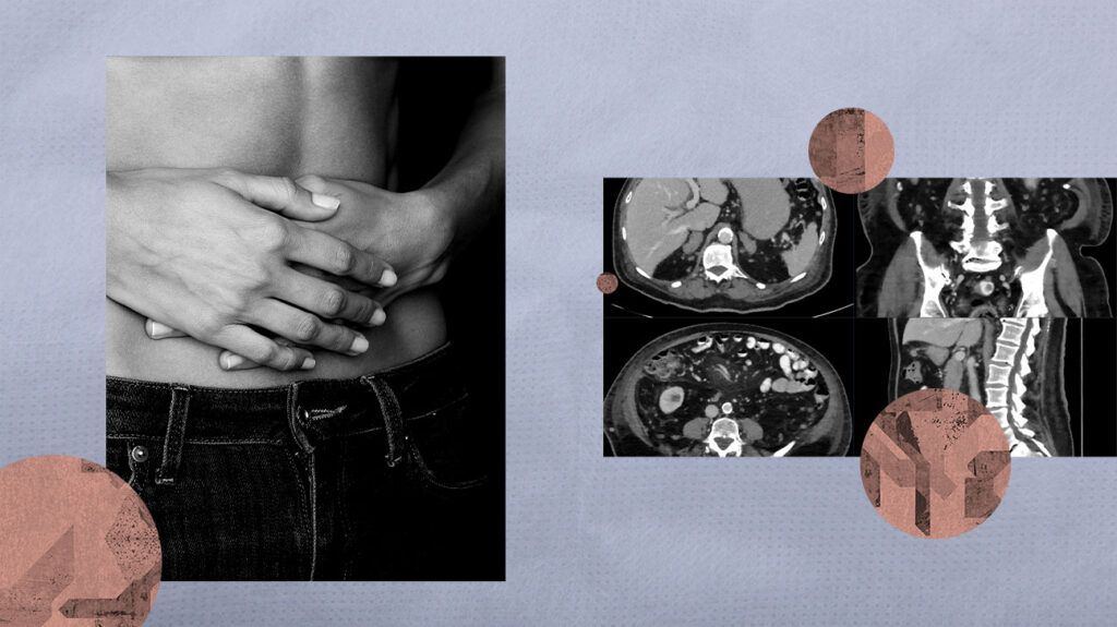 A collage representing adrenal metastasis. -2