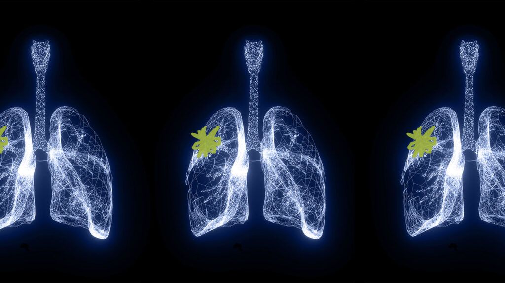 A blue-tinted X-ray of a lung