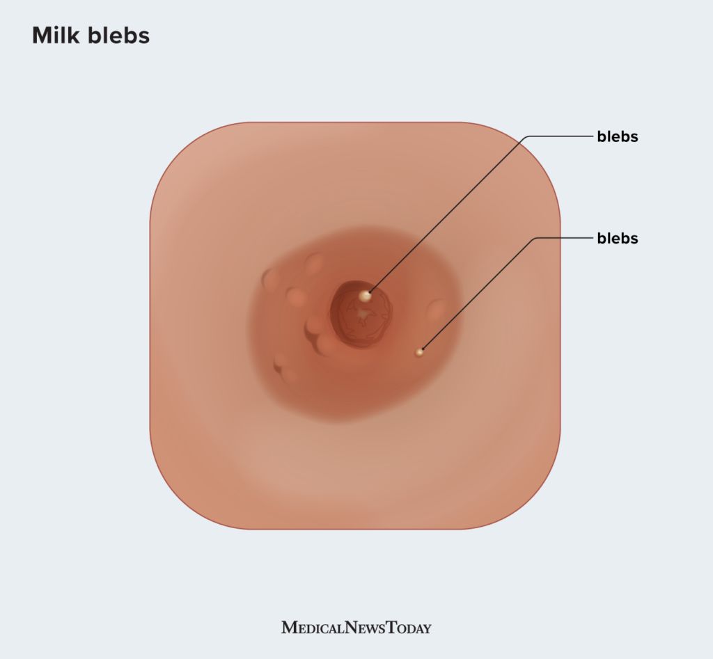 What are milk blebs? Symptoms, causes, and more