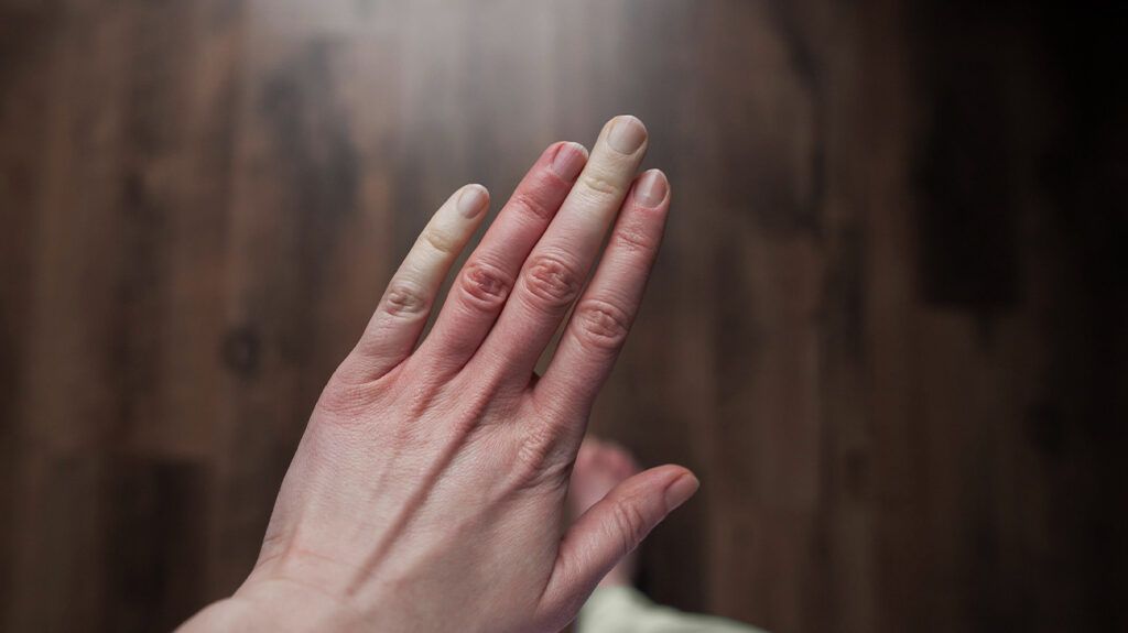A hand with Raynaud's disease. -2