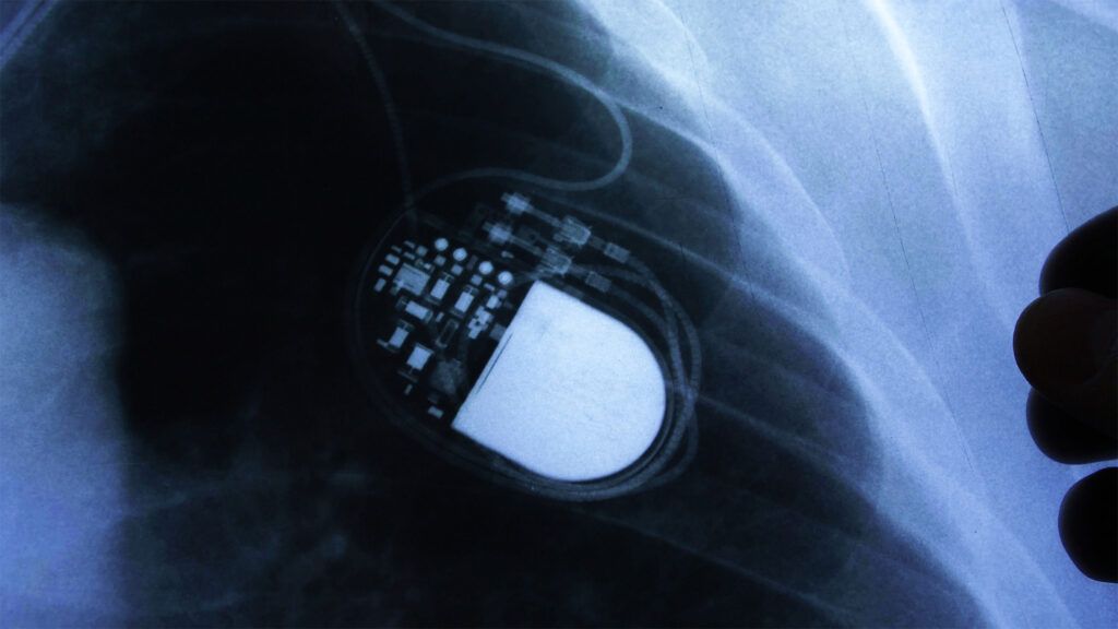 A medical image of a pacemaker-1.