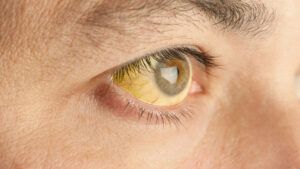 How to get rid of yellow eyes: Treatment and home remedies, image size:300x169