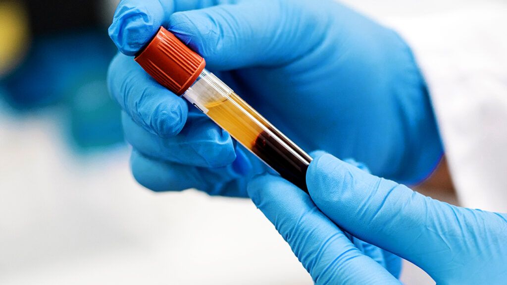 The anion gap blood test assesses the acid-base and electrolyte balance of the blood.