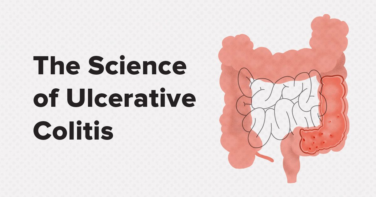 The Science Of Ulcerative Colitis